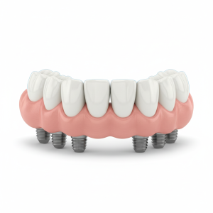 Prótese fixa sobre implantes